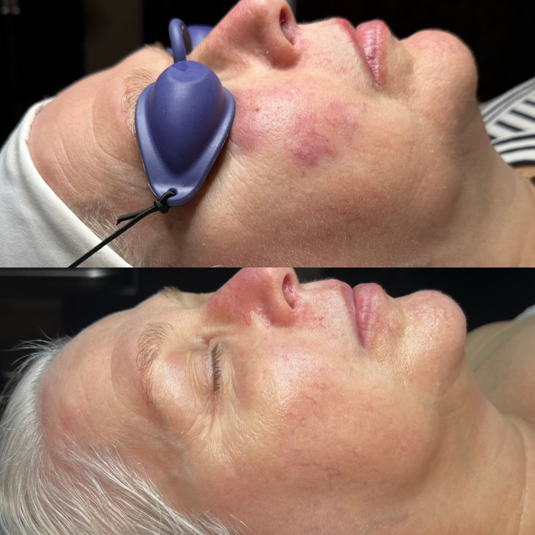 CALM Surprise Box (reactive skin, rosacea-prone, sensitivity, visible redness)