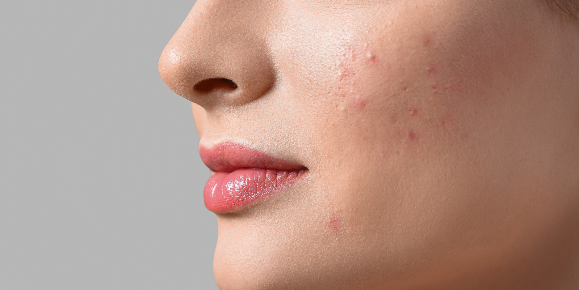A Journey Beyond the Surface: Healing Acne vs. Suffocating Acne – Fleur ...