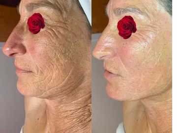 Filler facial 250$