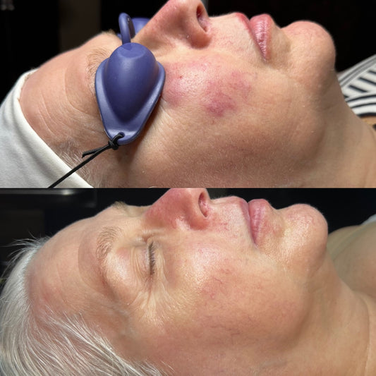 CALM Surprise Box (reactive skin, rosacea-prone, sensitivity, visible redness)