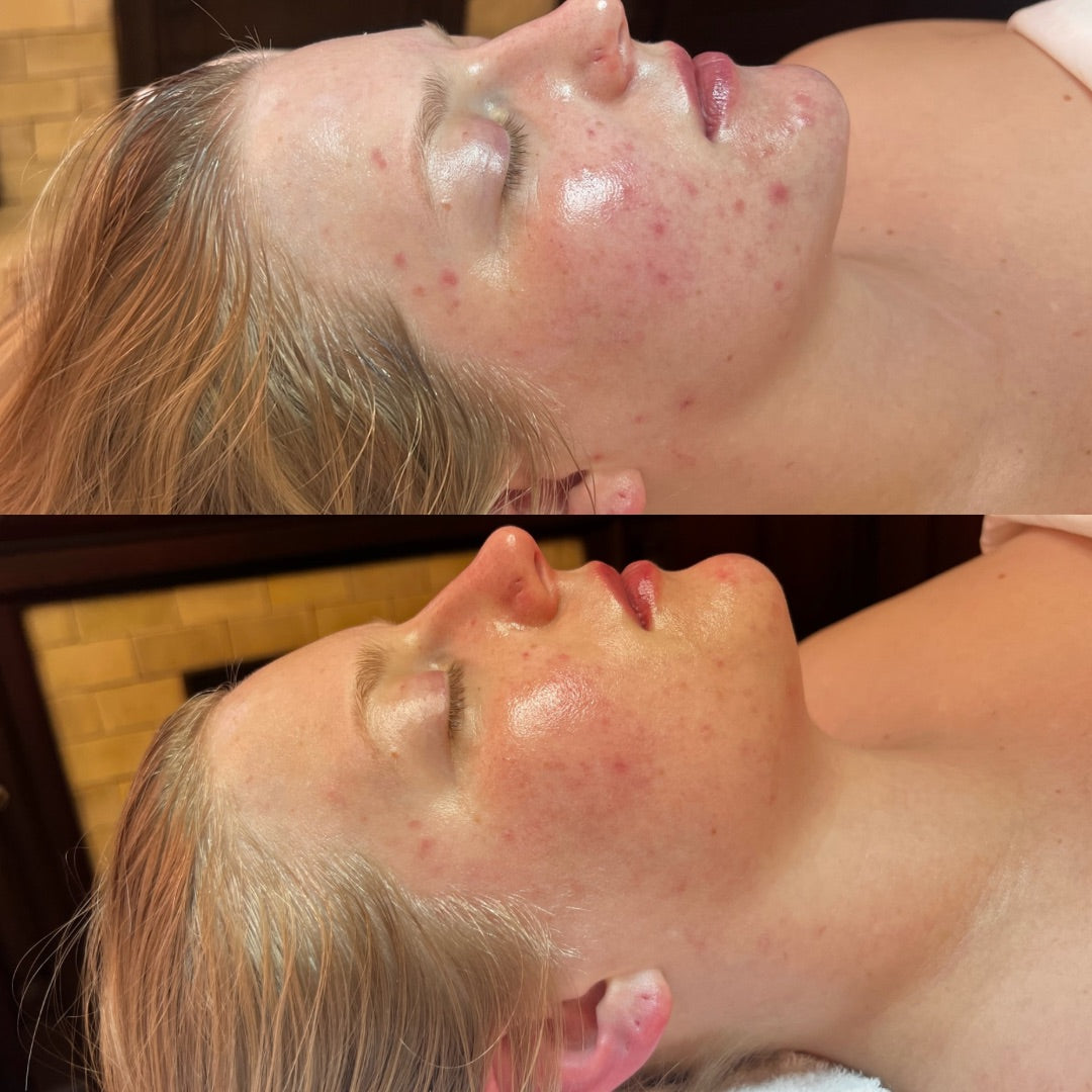 CLEAR Suprise Box (acne-prone, congestion, inflammation)